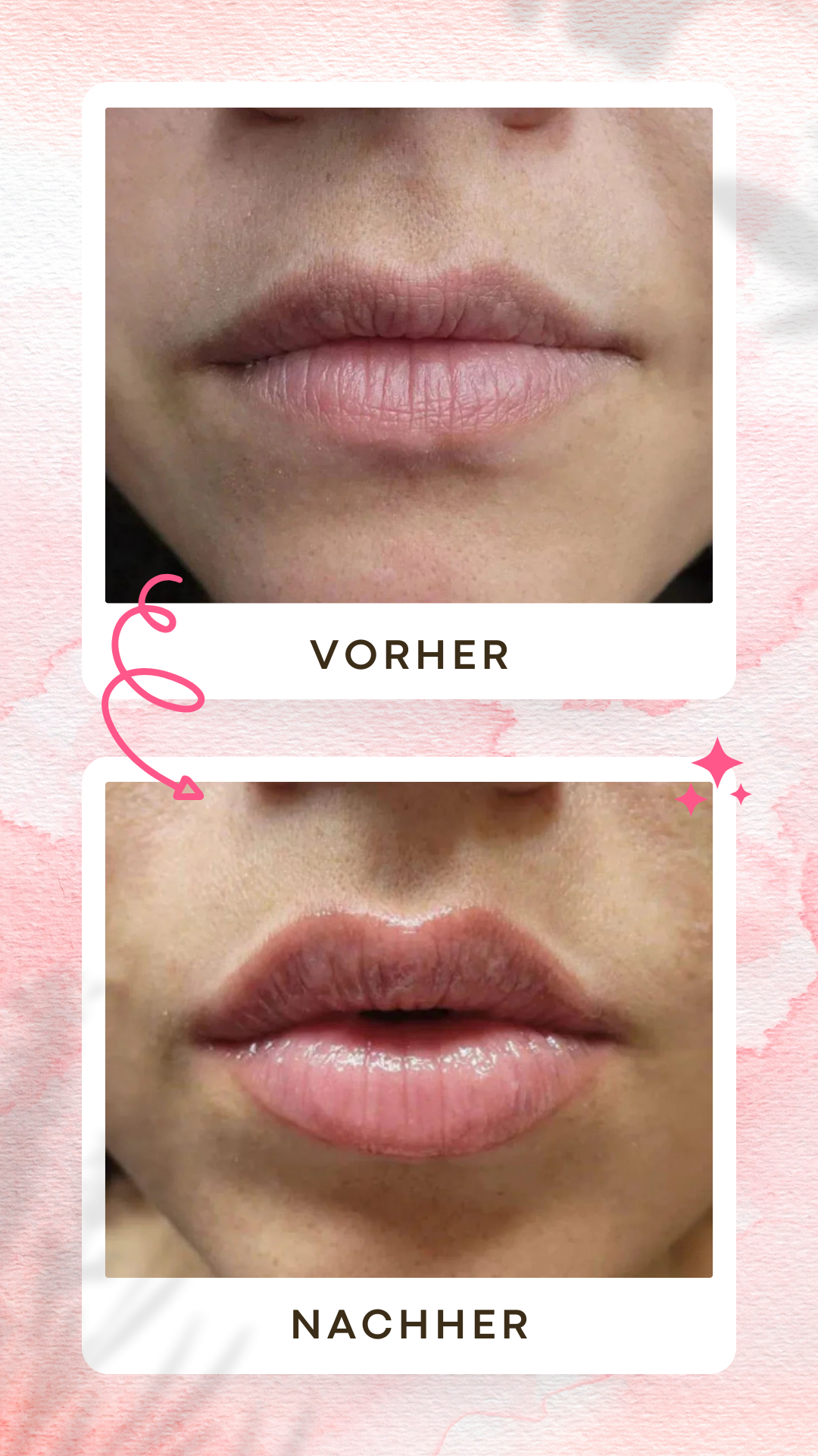 ShinyLips Lippen Booster Set