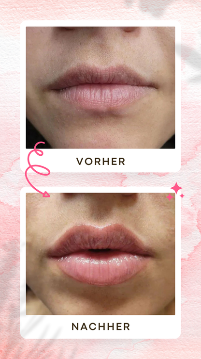 ShinyLips Lippen Booster Set